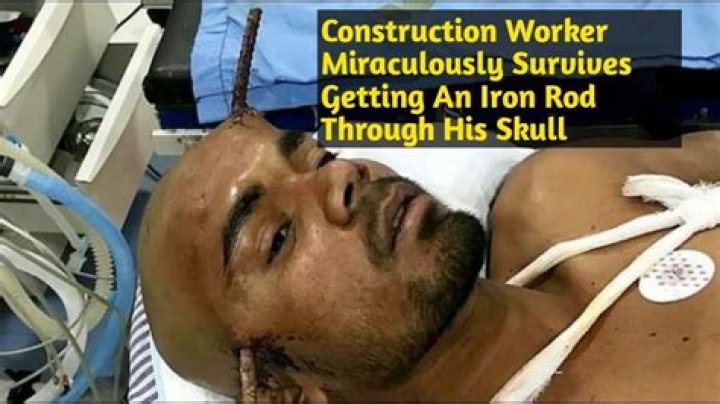 Indian Construction Worker Survives Iron Rod Going Through His Skull